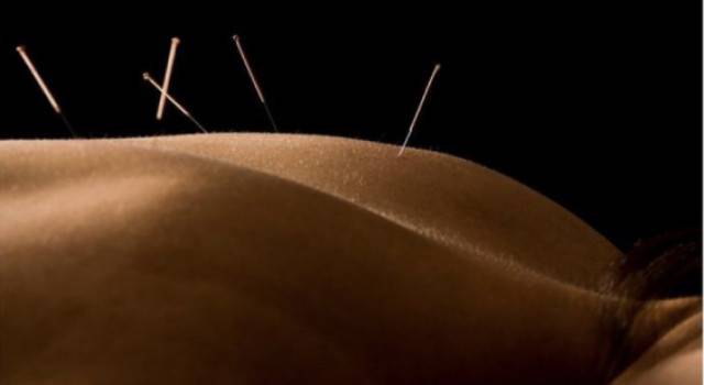 Acupuncture