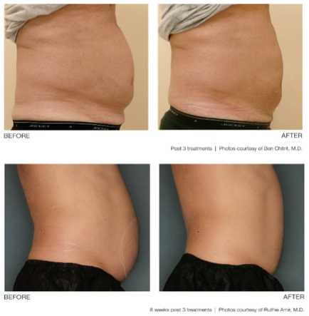 belly, ultra shape, before and after, Edmonton spa, Edmonton body contouring, Edmonton ultrashape